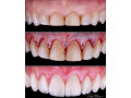 teeth-crown-lengthening-in-kampala-small-0