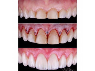 Teeth crown lengthening in kampala