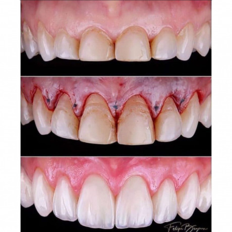 teeth-crown-lengthening-in-kampala-big-0