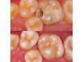 teeth-treatment-in-kampala-with-composite-small-0