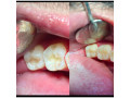 teeth-cavity-fillings-in-kampala-small-0