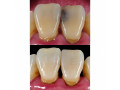 teeth-treatment-near-me-small-0