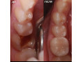 tooth-cavity-filling-treatment-near-me-small-1