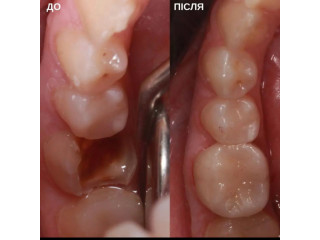 Tooth cavity filling treatment near me