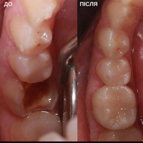 tooth-cavity-filling-treatment-near-me-big-1