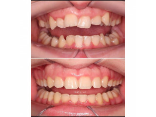 Teeth alignment with crowns near me