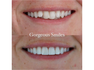 Teeth smile restoration with crowns near me