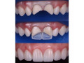 teeth-shape-building-with-composite-resins-near-me-small-0