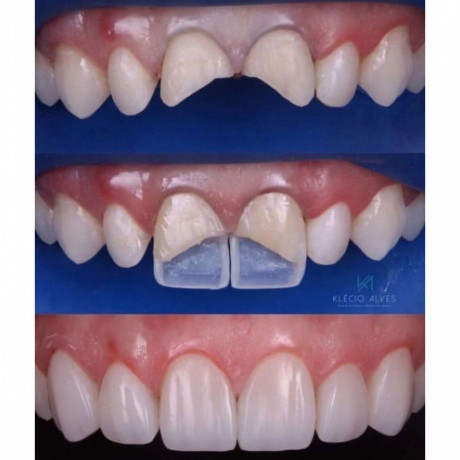 teeth-shape-building-with-composite-resins-near-me-big-0