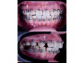 teeth-alignment-with-braces-in-kampala-near-me-small-0