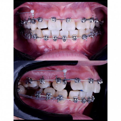 teeth-alignment-with-braces-in-kampala-near-me-big-0