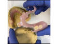 flexible-denture-for-teeth-replacement-in-kampala-uganda-small-0