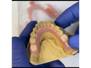 Removable denture for teeth replacement in Kampala Uganda