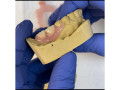 partial-denture-for-teeth-replacement-in-kampala-near-me-small-1