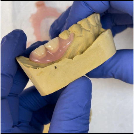 partial-denture-for-teeth-replacement-in-kampala-near-me-big-1