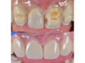 dental-teeth-treatment-with-crowning-in-kampala-near-me-small-0