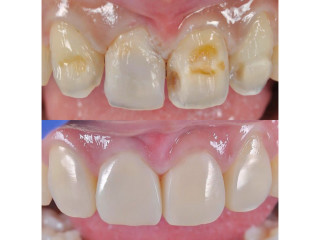 Dental teeth treatment with crowning in kampala near me