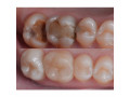 teeth-cavity-filling-in-kampala-near-me-small-0