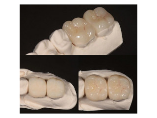 Teeth fabrication for teeth replacement in Kampala