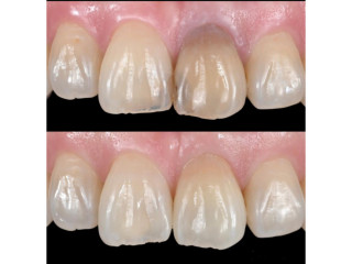 Teeth restoration in kampala near me