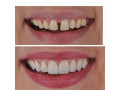 diastema-closure-with-crowns-in-kampala-near-me-small-0