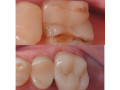 dental-filling-in-kampala-near-me-small-1