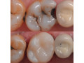 dental-filling-in-kampala-near-me-small-0