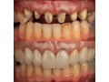 restoration-of-teeth-with-crowns-in-kampala-small-0