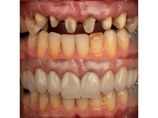 Restoration of teeth with crowns in kampala