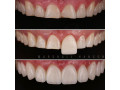 teeth-crown-lengthening-in-kampala-near-me-small-0