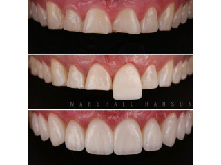 Teeth crown lengthening in kampala near me