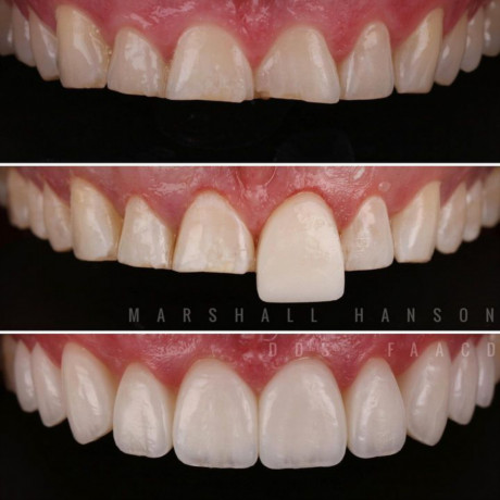 teeth-crown-lengthening-in-kampala-near-me-big-0