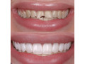 chipped-teeth-treatment-in-kampala-near-me-small-0