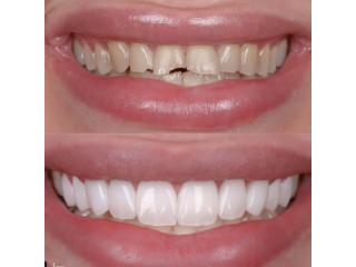 Chipped teeth treatment in Kampala near me