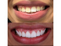 teeth-whitening-in-kampala-with-crowns-small-0