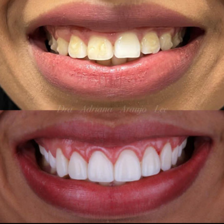 teeth-whitening-in-kampala-with-crowns-big-0