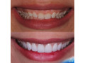 teeth-height-correction-with-crowns-in-kampala-near-me-small-0