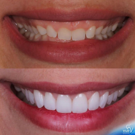 teeth-height-correction-with-crowns-in-kampala-near-me-big-0