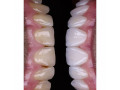 teeth-color-correction-with-composite-in-kampala-small-0