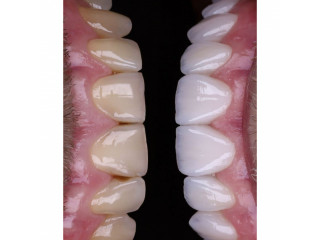 Teeth color correction with composite in kampala