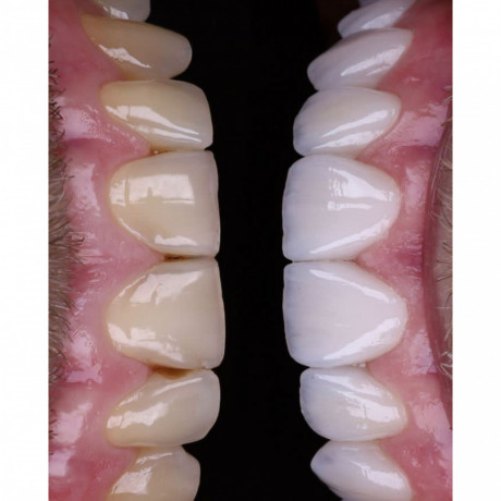 teeth-color-correction-with-composite-in-kampala-big-0