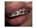 teeth-gems-on-braced-teeth-in-kampala-small-0