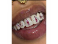 teeth-gem-stones-design-in-kampala-near-me-small-0