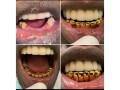 teeth-replacement-with-gold-crowns-in-kampala-near-me-small-0