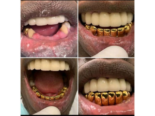 Teeth replacement with gold crowns in kampala near me