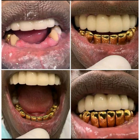 teeth-replacement-with-gold-crowns-in-kampala-near-me-big-0