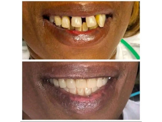 Oral teeth treatment in Kampala