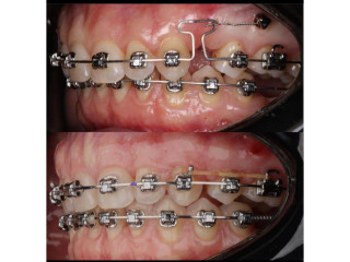 Teeth braces in kampala near me