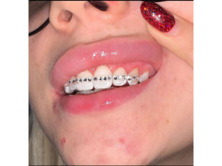 Teeth braces mimick gem designs in kampala