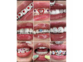 different-types-of-teeth-gem-stones-design-in-kampala-near-me-small-0